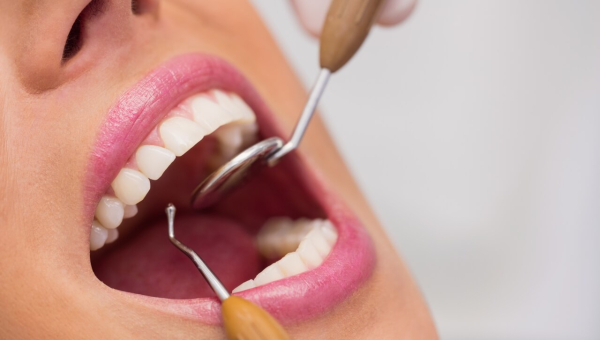 Yuk Ketahui Perbedaan Tambal Gigi dan Tambal Estetik