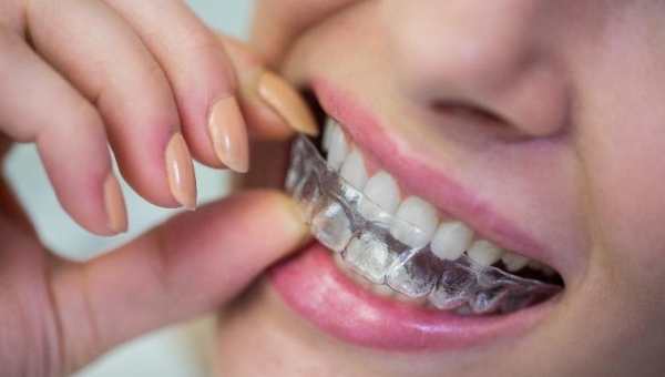 Mau Pasang Kawat Gigi? Jangan Sampai Lupa Hal Ini Ya!