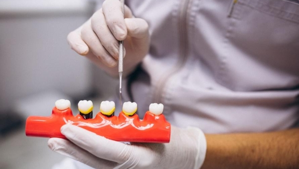 Kapan Sebaiknya Melakukan Scaling Gigi?